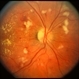 CMV with leukemia